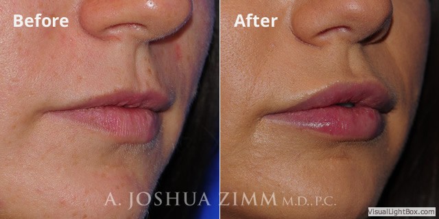 Lip Injections NYC | Dr. Joshua Zimm | Manhattan Chin Implant