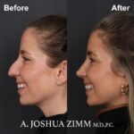 Rhinoplasty Before and After