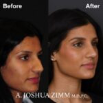 Rhinoplasty - Before and After