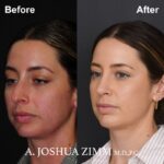 Rhinoplasty - Before and After