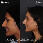 Rhinoplasty - Before and After