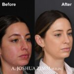 Rhinoplasty - Before and After