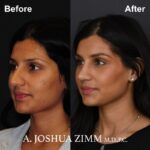 Rhinoplasty - Before and After