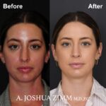 Rhinoplasty - Before and After