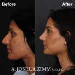 Rhinoplasty - Before and After