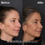 Rhinoplasty Before and After