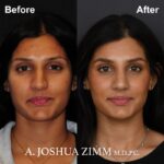 Rhinoplasty - Before and After