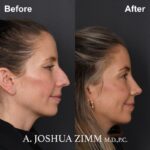 Rhinoplasty Before and After