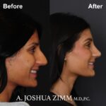 Rhinoplasty - Before and After