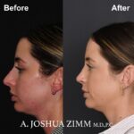 Rhinoplasty - Before and After