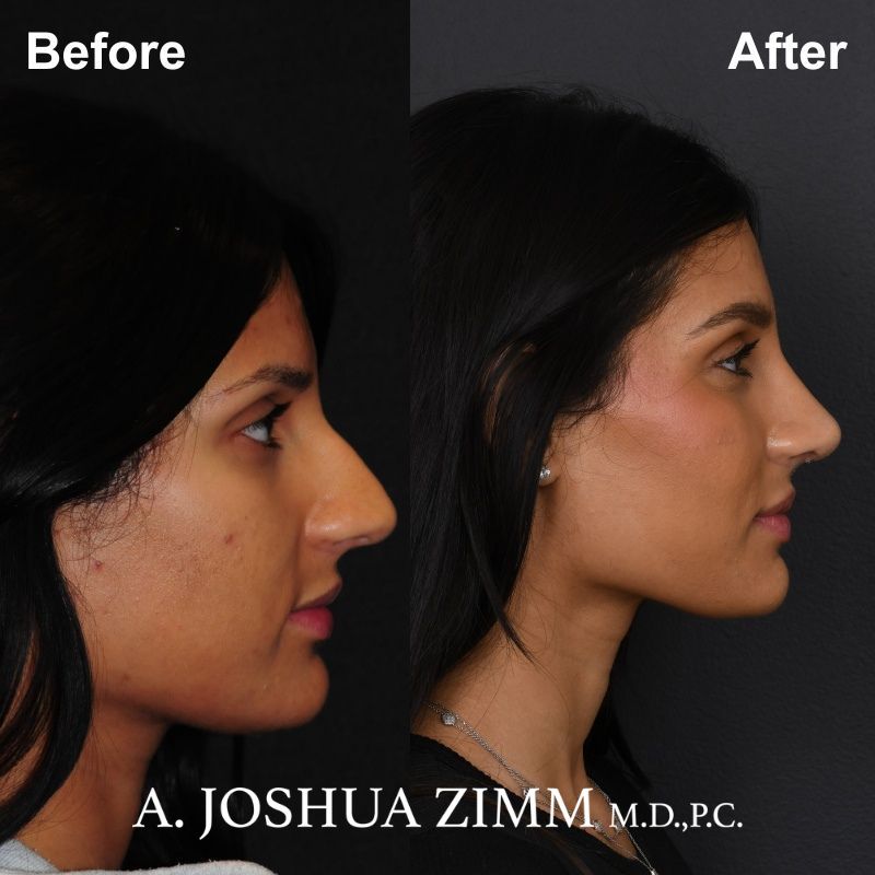 Rhinoplasty - Before and After