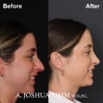 Rhinoplasty - Before and After