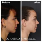 Otoplasty - Before and After