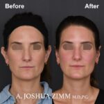 Otoplasty - Before and After