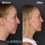 Chin implant - before and after