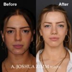 Revision Rhinoplasty - Before and After