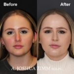 Revision Rhinoplasty - Before and After