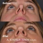 Revision Rhinoplasty - Before and After