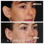 Otoplasty - Before and After