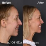 Chin implant - before and after