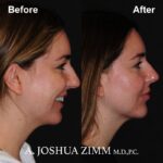 Chin implant - before and after