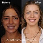 Revision Rhinoplasty - Before and After