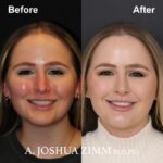 Revision Rhinoplasty - Before and After