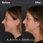 Revision Rhinoplasty - Before and After