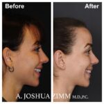 Otoplasty - Before and After