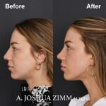 Revision Rhinoplasty - Before and After