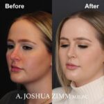 Revision Rhinoplasty - Before and After