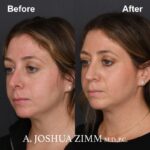 Revision Rhinoplasty - Before and After