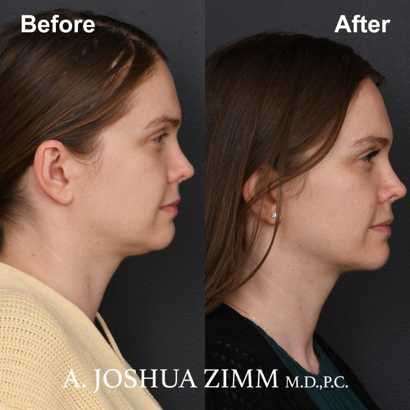 Facetite Contouring New York Facial Plastic Surgeon Dr. Joshua Zimm ...