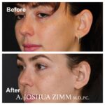 Otoplasty - Before and After