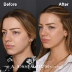 Revision Rhinoplasty - Before and After