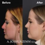 Revision Rhinoplasty - Before and After