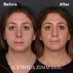 Revision Rhinoplasty - Before and After