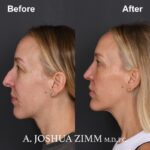 Chin implant - before and after