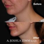 Chin implant - before and after