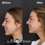 Revision Rhinoplasty - Before and After