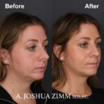 Revision Rhinoplasty - Before and After