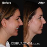 Chin implant - before and after