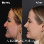 Revision Rhinoplasty - Before and After