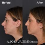 Revision Rhinoplasty - Before and After