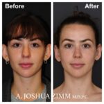 Otoplasty - Before and After