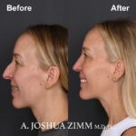 Chin implant - before and after