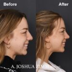 Revision Rhinoplasty - Before and After