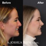 Revision Rhinoplasty - Before and After