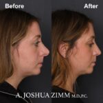 Revision Rhinoplasty - Before and After