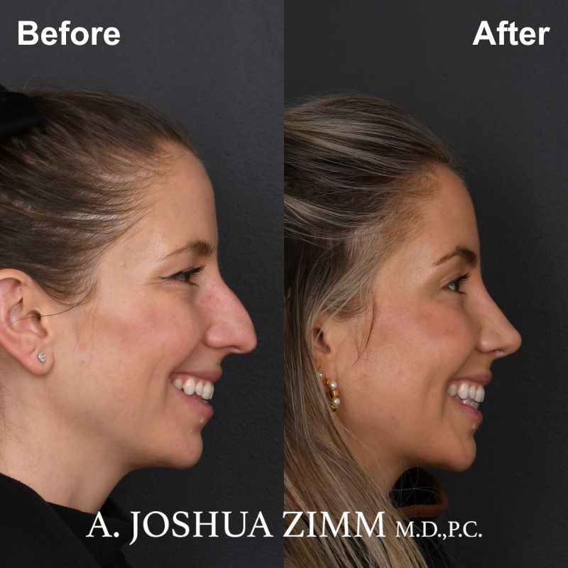 Rhinoplasty Before and After